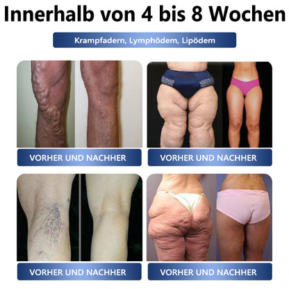 𝑻𝒓𝒂𝒈𝒃𝒂𝒓𝒆 𝑳𝒚𝒎𝒑𝒉𝒂𝒕𝒊𝒔𝒄𝒉𝒆 𝑬𝒏𝒕𝒈𝒊𝒇𝒕𝒖𝒏𝒈 👩🏼‍⚕️𝑶𝒓𝒊𝒈𝒊𝒏𝒂𝒍 2-𝒊𝒏-1-𝑻𝒉𝒆𝒓𝒂𝒑𝒊𝒆 | 𝑷𝑲𝑵𝑵𝑬𝑾® 𝑼𝒍𝒕𝒓𝒂𝒔𝒄𝒉𝒂𝒍𝒍 𝒛𝒖𝒎 𝑭𝒆𝒕𝒕𝒂𝒃𝒃𝒂𝒖 𝒖𝒏𝒅 𝑬𝑴𝑺 𝒛𝒖𝒓 𝑩𝒍𝒖𝒕𝒛𝒖𝒄𝒌𝒆𝒓𝒃𝒂𝒍𝒂𝒏𝒄𝒆 👑