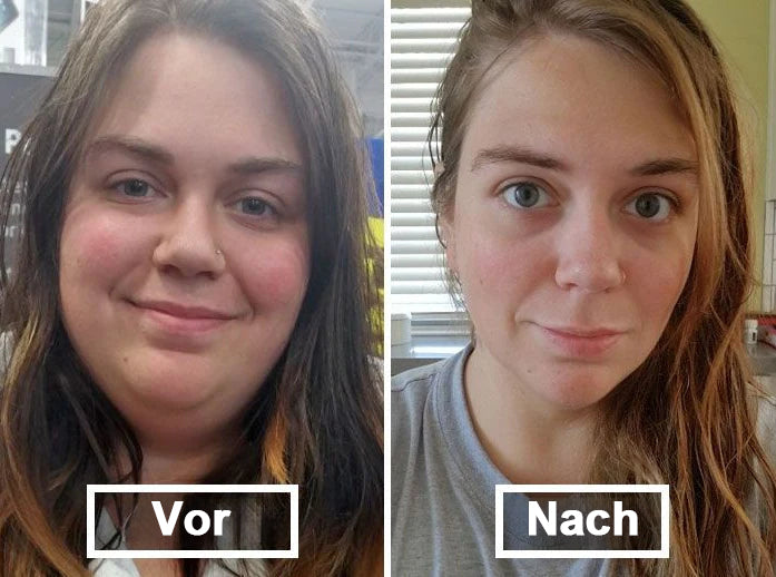 【Letzter Tag der Aktion –60 %】TLOPA® Schlankheits- & Gesundheits-Pflaster mit NANO-MIKRONADELN Tirzepatid-NIDDK 💕（Schmerzfrei, 24h-Wirkstofffreisetzung | Schnell 9 kg abnehmen | 90 % Zuckerreduktion）
