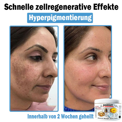 Verbesserung innerhalb von 7 Tagen⏰𝘿𝙤𝙧𝙢𝙤𝙧𝙤𝙣𝙖™ 🌵𝙈𝙪𝙡𝙩𝙞𝙨𝙮𝙢𝙥𝙩𝙤𝙢 𝘽𝙞𝙚𝙣𝙚𝙣𝙜𝙞𝙛𝙩 𝘽𝙚𝙧𝙪𝙝𝙞𝙜𝙪𝙣𝙜𝙨𝙘𝙧𝙚𝙢𝙚(👨‍⚕𝐃𝐃𝐆 𝐄𝐦𝐩𝐟𝐨𝐡𝐥𝐞𝐧) (𝐄𝐧𝐭𝐟𝐞𝐫𝐧𝐭 𝐀𝐤𝐧𝐞, 𝐖𝐚𝐫𝐳𝐞𝐧, 𝐑𝐨𝐬𝐚𝐜𝐞𝐚, 𝐏𝐬𝐨𝐫𝐢𝐚𝐬𝐢𝐬, 𝐀𝐥𝐭𝐞𝐫𝐬𝐟𝐥𝐞𝐜𝐤𝐞𝐧, 𝐄𝐤𝐳𝐞𝐦𝐞 𝐮𝐧𝐝 𝐠𝐥ä𝐭𝐭𝐞𝐭 𝐃𝐞𝐡𝐧𝐮𝐧𝐠𝐬𝐬𝐭𝐫𝐞𝐢𝐟𝐞𝐧)