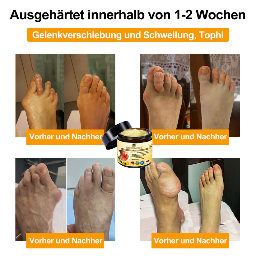 Aeehfeng™ 🎁Bienengift-Schmerzlinderungs Knochenheilungs Creme 👨‍⚕️Deutsch (BfArM) genehmigt(Reduzierung von Gelenkschwellungen, Schmerzen, Steifheit, Rötungen, Wärme, Muskelkater und Gelenkmüdigkeit)